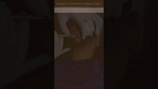 Alopecia Treatment at Skinaa Clinic | viral #shorts screenshot 3