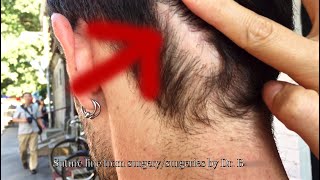 Living with 3 Hair Transplant Scars