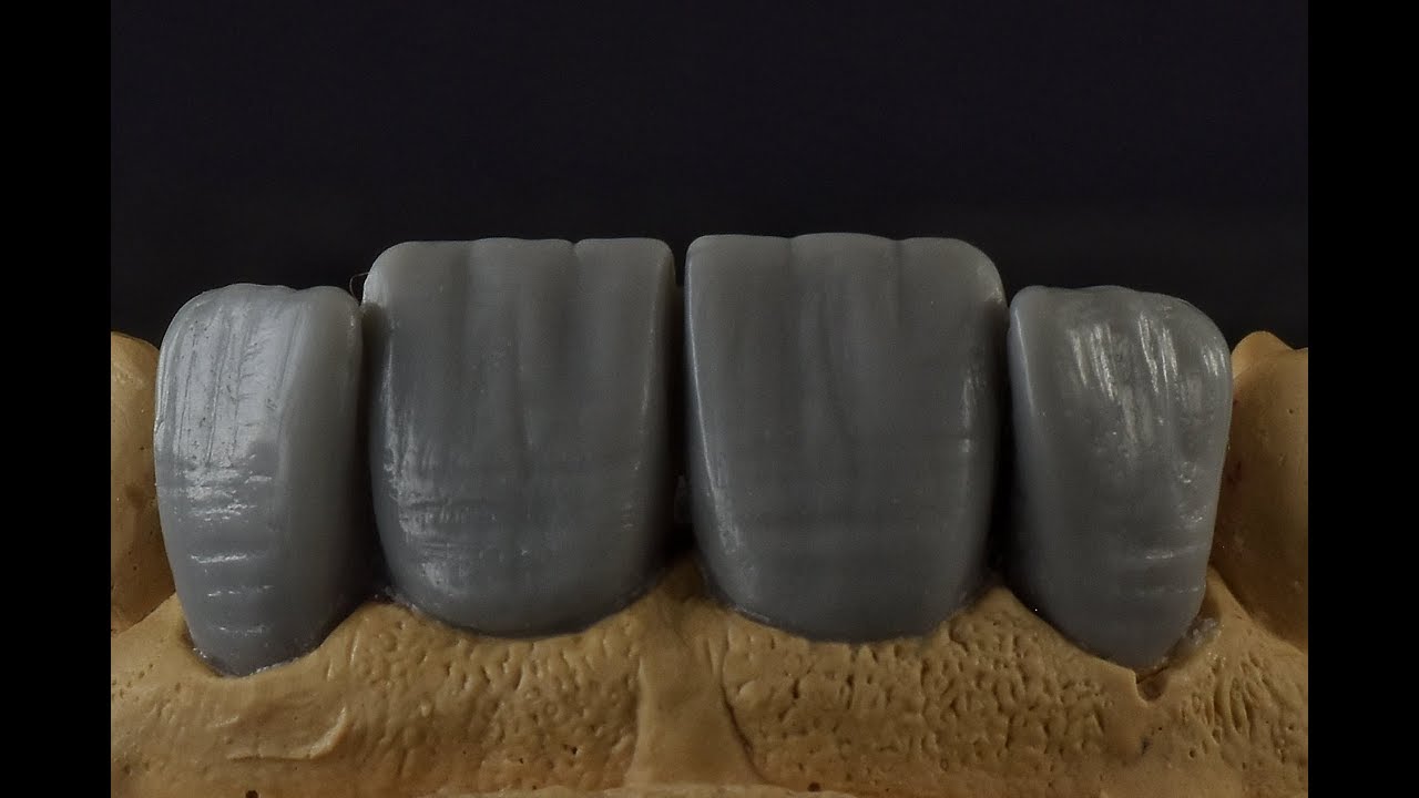 Wax up    Waxing of the upper lateral تشميع الرباعيات العلوية