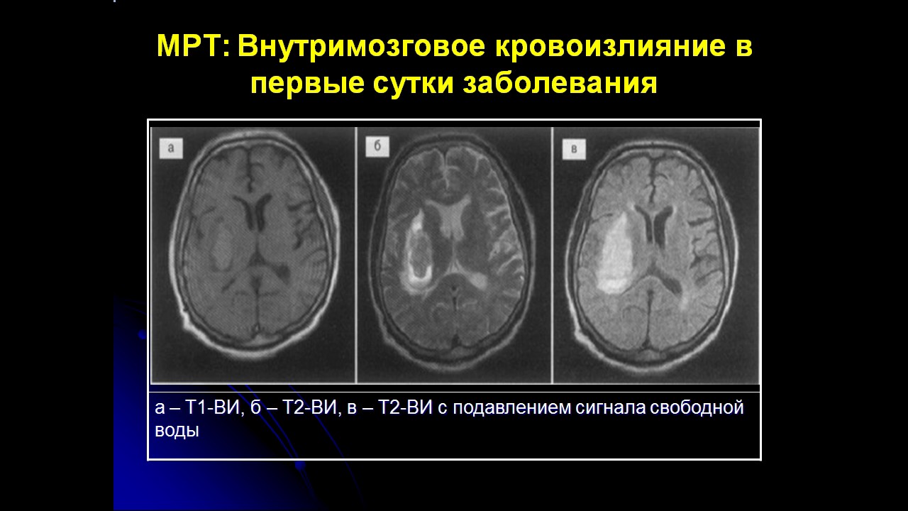 Инсульт 3 степени