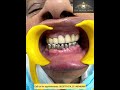 Patient’s Dental Treatment journey, from lot of difficulty in chewing Food, Pain
