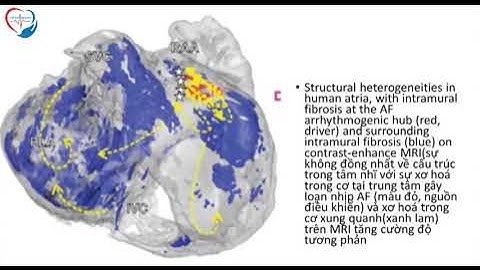 Những xu hướng mới trong cắt đốt rung nhĩ hiện nay