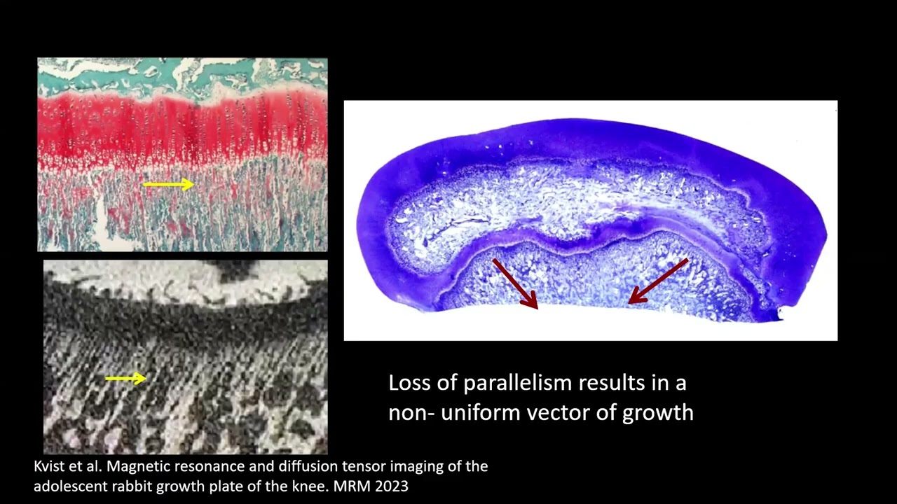 Diffusion Tensor Imaging for assessing physical function | Ola Kvist, MD, PhD