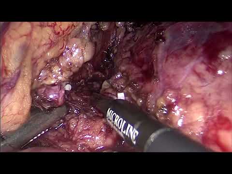 Лапароскопическая дистальная резекция поджелудочной железы