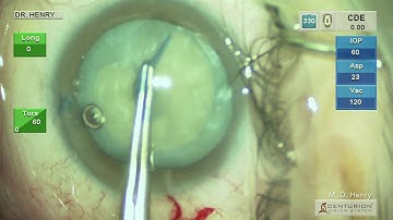"Little Maneuver" Cataract Capsulorhexis Rescue