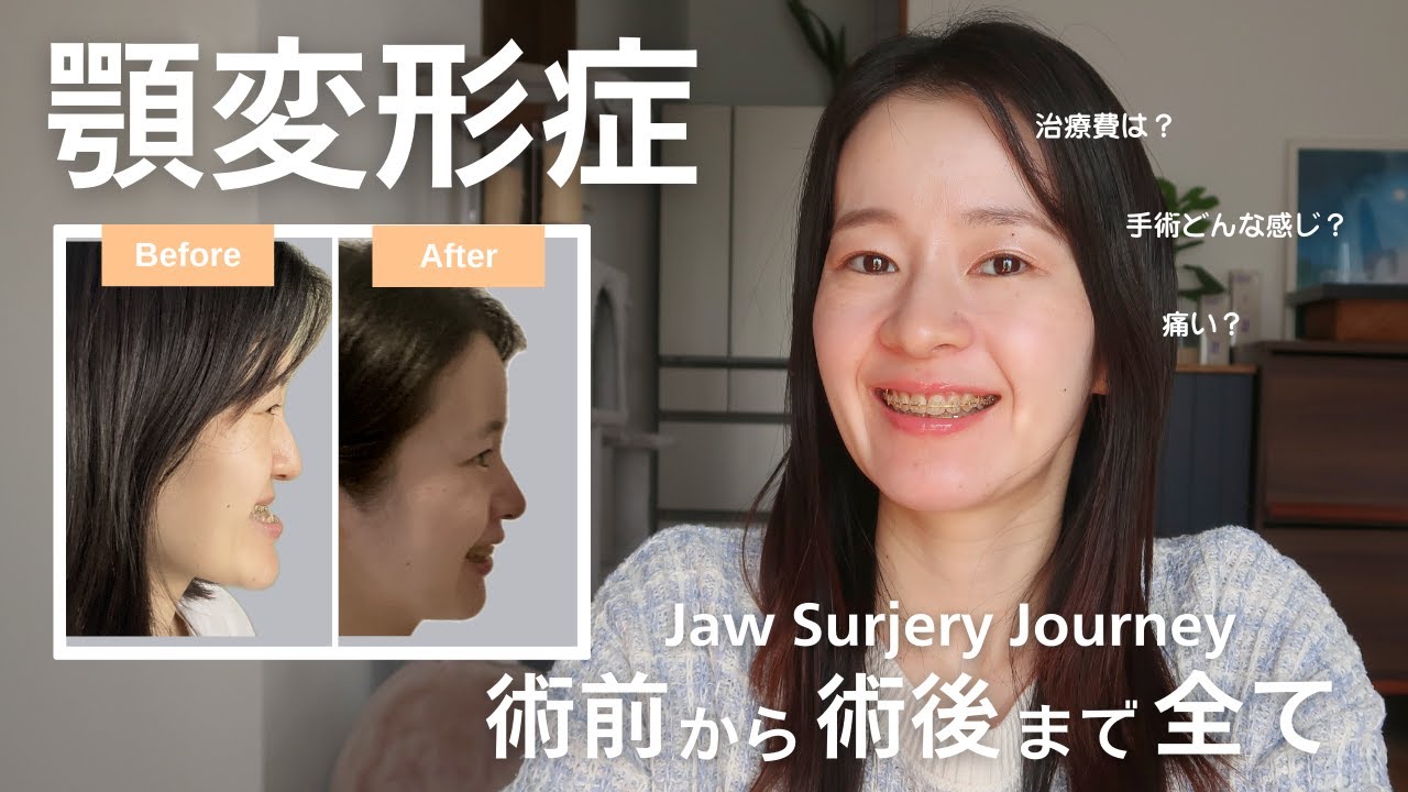 顎変形症の手術体験談：Before After、治療費から術後経過まで完全公開！