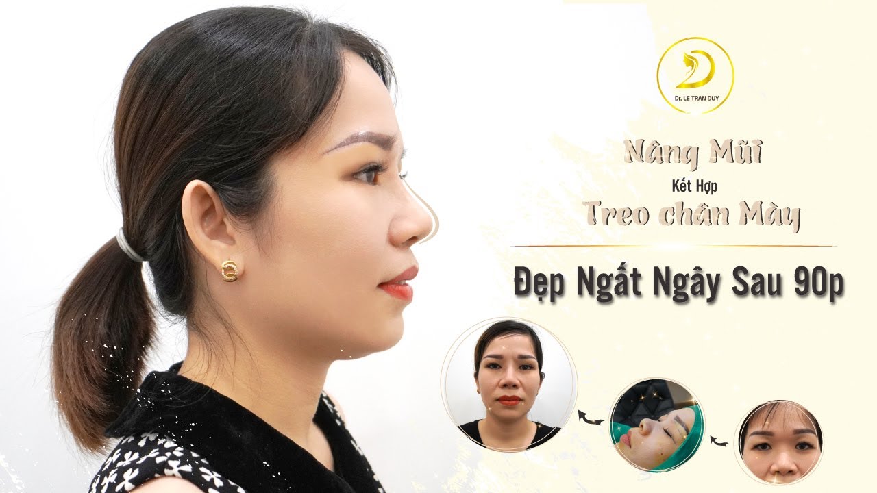 Nâng mũi kết hợp treo chân mày đẹp ngay sau 90p | Bs.Lê Trần Duy