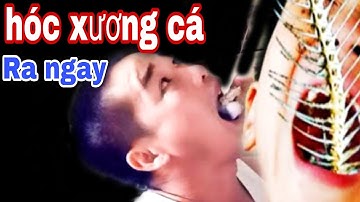 Mẹo Chữa HÓC XƯƠNG CÁ Tại nhà/ chỉ cần SỢI CHỈ Và BÔNG là Xương Cá Tự Văng Ra Ngoài
