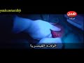 عملية الولادة القيصرية فيديو Cesarean Section