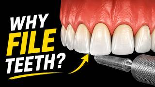 Why Do Dentists File Teeth | Tooth Reshaping Explained
