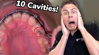 How Did He Brush Everyday And STILL Get Cavities?! 🦷🪥