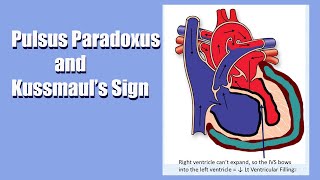 Pulsus Paradoxus &amp; Kussmaul&#39;s Sign: A Sign of Heart Trouble!  A Live Lecture...