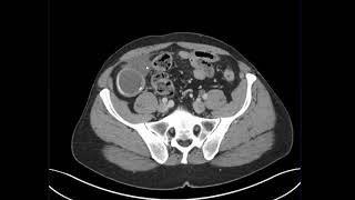 Appendix - Mucocele Perforation