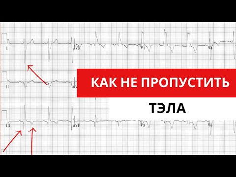 Как не пропустить тромбоэмболию легочной артерии (ТЭЛА). ЭКГ признаки ТЭЛА.