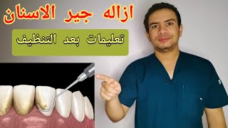 جير الاسنان كارثه تهدد اسنانك | ازاله جير الاسنان | اعراض جير الاسنان | نصائح بعد ازاله الجير