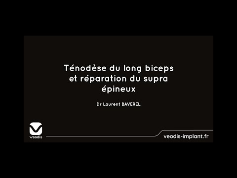 Vidéo: Ténodèse Du Biceps: Récupération, Efficacité, Procédure, Etc