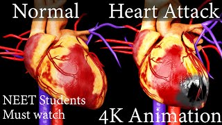 ANGIOPLASTY क्या है ? कैसे जान लेता है HEART ATTACK? NEET 4k Animation Hindi.