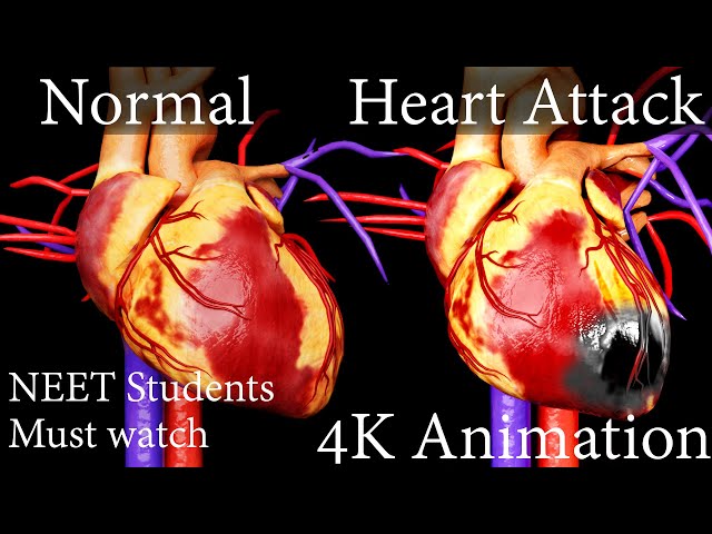 ANGIOPLASTY क्या है ? कैसे जान लेता है HEART ATTACK? NEET 4k Animation Hindi. class=