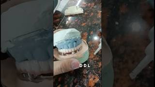 Lower implant bridge #dentist #lab #public #cermic