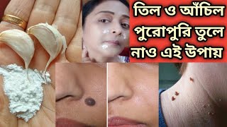 তিল ও আঁচিল পুরোপুরি তুলে নাও এই উপায়/Remove Til ,Warts Naturally/Effective Home Remedy for Til