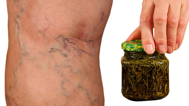 Unbelievable! Varicose veins disappear with the he...