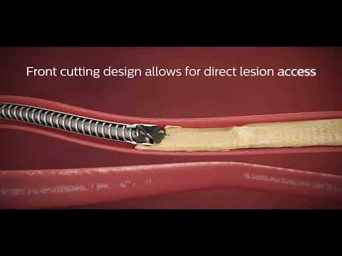 Cut, capture, clear - Philips Phoenix Atherectomy Mechanical System