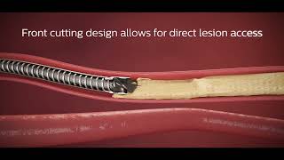 Cut, capture, clear - Philips Phoenix Atherectomy Mechanical System