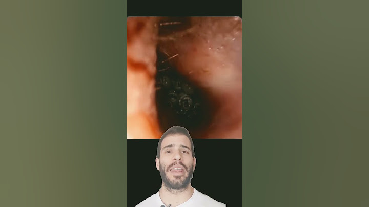 Ear myiasis: How do you get the bugs out of the ear canal?