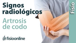 Roto dentro del codo sanguíneo vaso