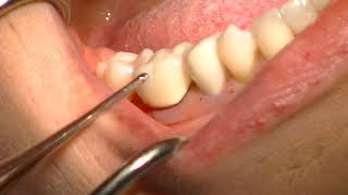 WAMKey Crown Removal - Bridge Removal - WAM key Crown Remover - GoldenDent