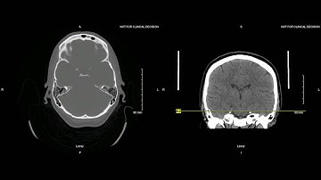 Unremarkible Non Contrast CT Axial Bone Window  Example 2