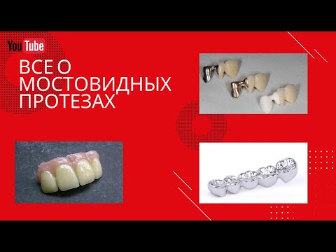 Всё о мостовидных протезах | All about dental bridge