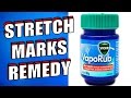 How to Remove Stretch Marks Using Vicks Vaporub