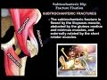 Femur fracture ,Subtrochanteric fracture - Everything You Need To Know - Dr. Nabil Ebraheim