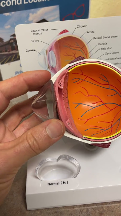 What is Keratoconus? #shorts