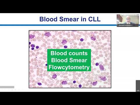 Video: Monoalelní A Bialelické Delece 13q14 Ve Skupině Pacientů S CLL / SLL Vyšetřených Pomocí CGH Haematological Cancer A SNP Array (8x60K)