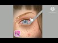 How to make Eyes Attractive with Eyes surgery Animation ASMR video