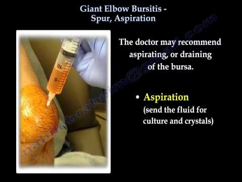 Videó: A Láb Teteje: Bursitis, Bone Spur és így Tovább