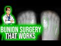 Watch How Fast Bunion Surgery Can Work** Just 10 days**!