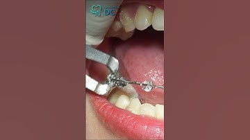 Hành Trình 3 Năm Niềng Răng: Biến Đổi Nụ Cười Cùng Nha Khoa Bác Sĩ Cường | Dr Cường Official