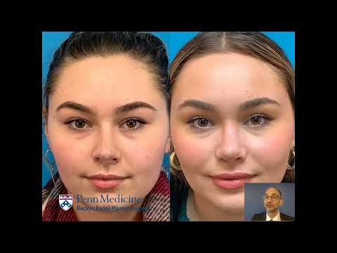 Video thumbnail: Rhinoplasty: Fixing a crooked nose-Becker Plastic Surgery · Becker Aesthetics & Plastic Surgery