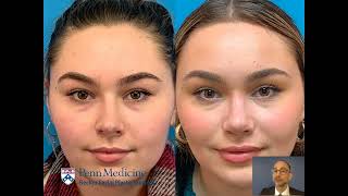 Rhinoplasty: Fixing a crooked nose-Becker Plastic Surgery