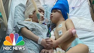 Conjoined Twins Separated After 27 Hours Of Surgery