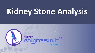 Kidney Stone Analysis