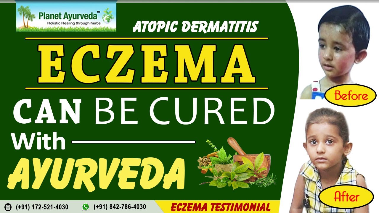 Eczema can be cured by Ayurveda with Herbal Remedies & Diet YouTube