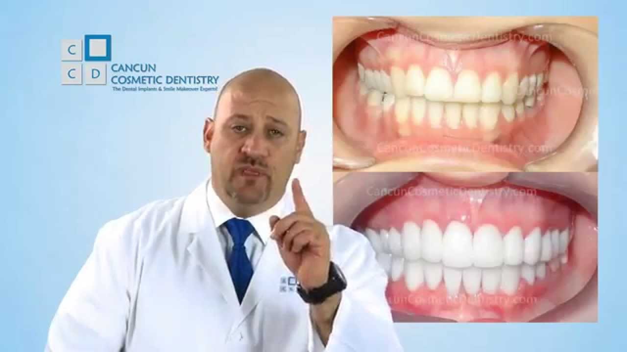 Dental Crowns Procedure In Mexico Explained 👑 Casting Dental Crowns in