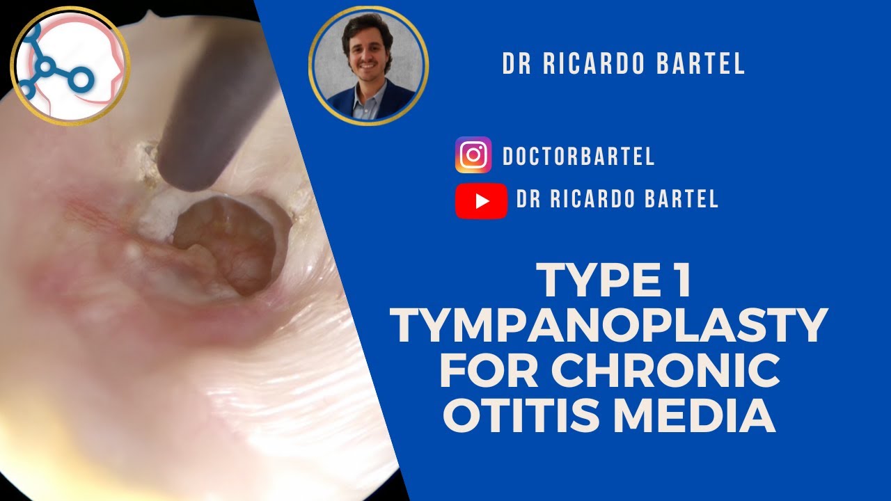 Type 1 tympanoplasty for chronic mucosal (suppurative) otitis media