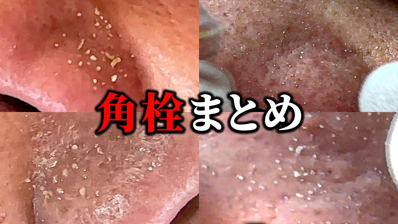 角栓出し4連発! - YouTube