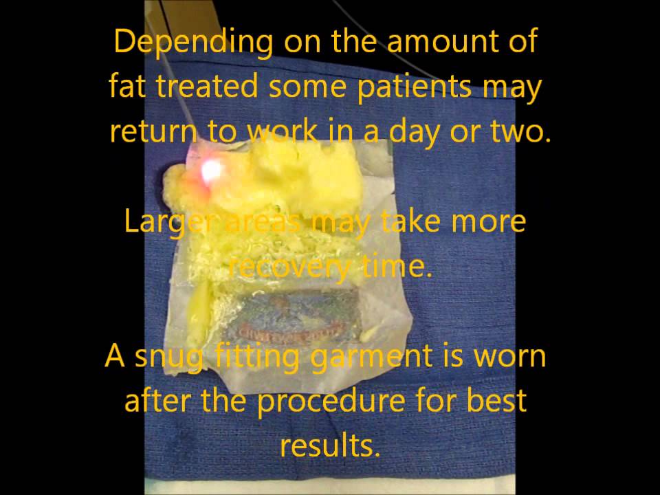 Dr  Gorodisky demonstrating SlimLipo laser for fat melting