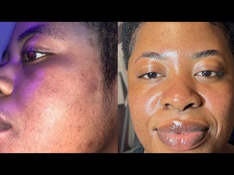 Video: Jinsi ya Kuondoa Blackheads Kawaida (Njia ya Mvuke na Kitambaa)